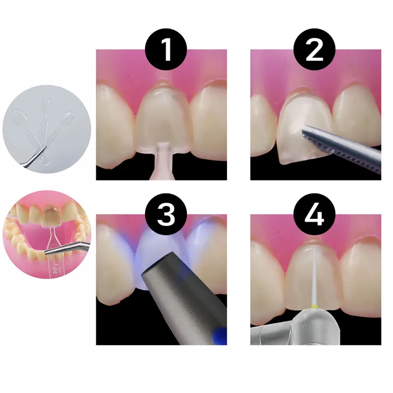 32pcs/Set Composite Resin Mold Light Cure Light Cure Autoclave Dental Veneer Mould Kit M/L Front Teeth Mould Teeth Whitening