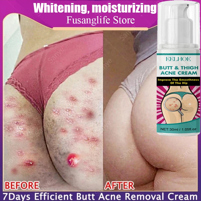 

Body Acne Treatment Cream Clearing Dark Spots Pimples Moisturizing Lotion Butt Inner Thigh Whitening Serum Buttock Smooth Cream