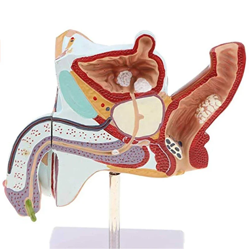 Male Internal Reproductive Pathology Model Male Reproductive Disease Anatomical Model Male Urinary System Disease Model