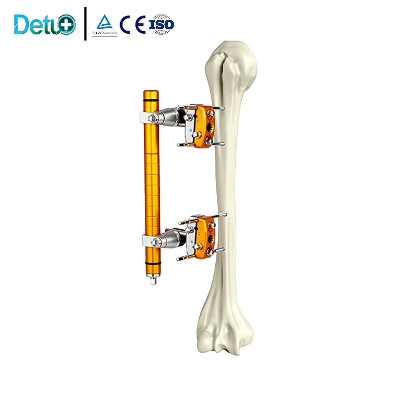 Hoffmann Type Orthopedic External Fixator, Compression Distraction Telescopic Rod, Single For Upper Limb External Fixation