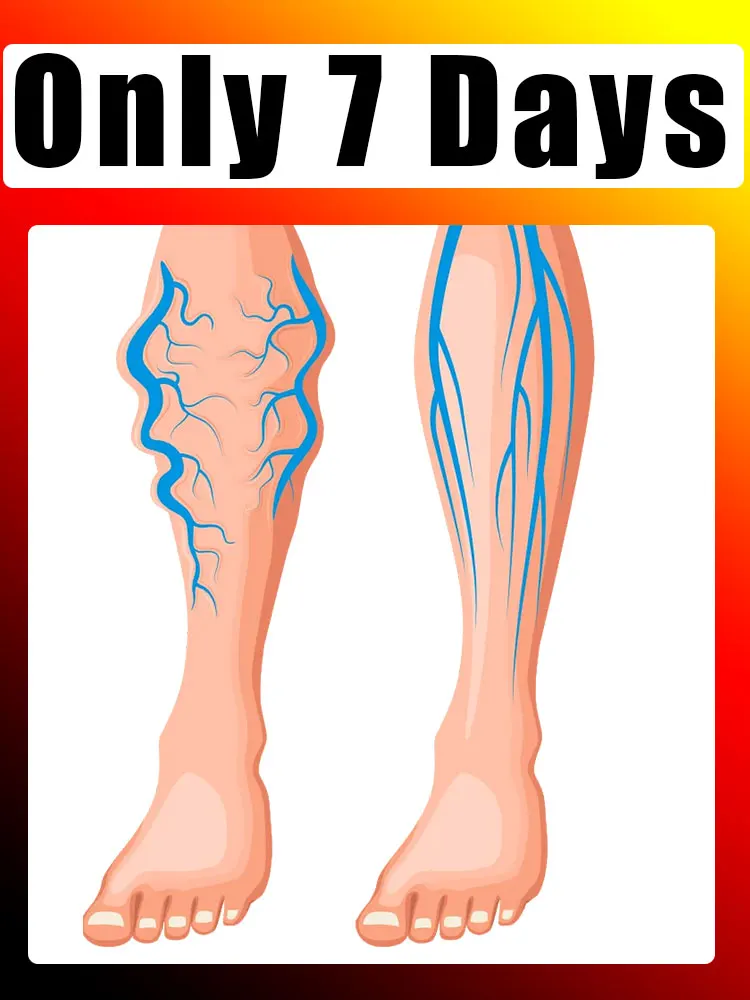 Outil laser de deuxième génération de vente chaude, sûr et sans douleur pour les varices.