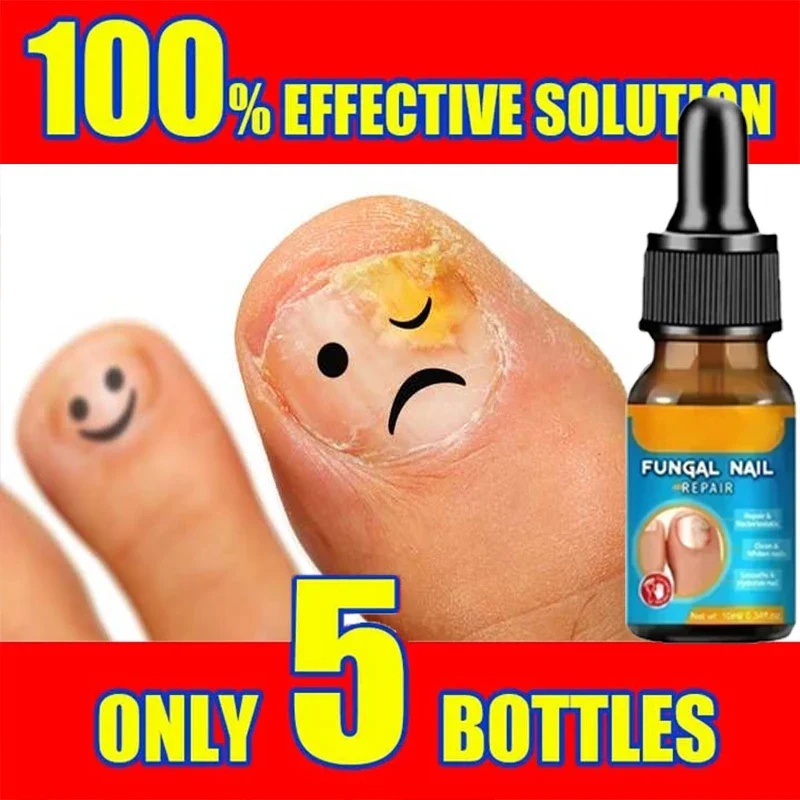 Nail Fungal Treatment Feet Care Essence Nail Foot Care Toe Nail Fungus Removal Gel Anti Infection Paronychia Onychomycosis