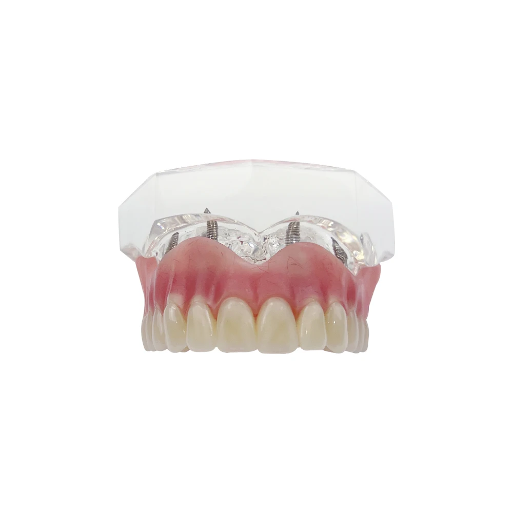 M6001 Dentes Dentais Modelo para Estudante Dentista, Modelos de Comunicação para Paciente, Overdenture, Odontologia, Maxila Superior, 4 Implantes