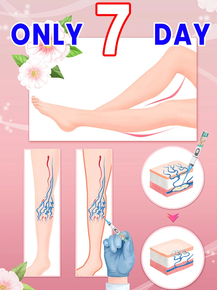 

The second generation of new technology blue light laser pointer for varicose veins