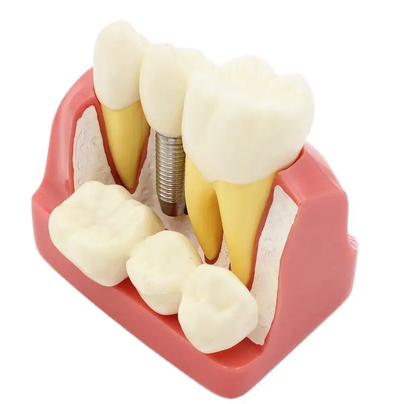 Removível Crown Bridge Model para Demonstração Dentes, Dental Teach Implant Analysis