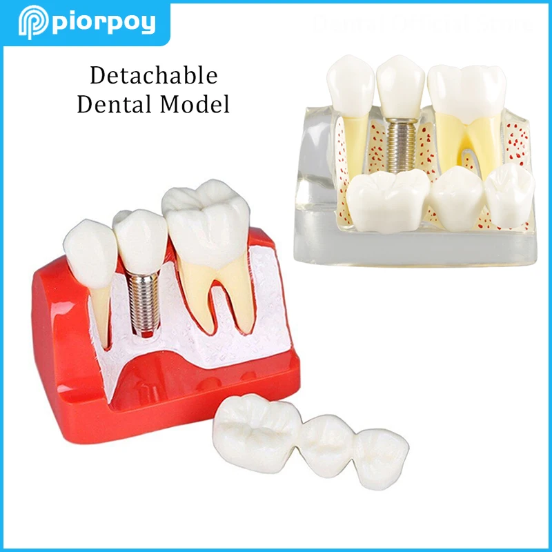 PIORPOY Dental Teaching Model 4 Times Implant Tooth Model Removable Analysis Crown Bridge Demonstration Mold For Dentistry