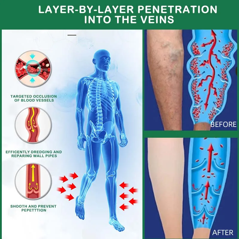 Pomada para veias varicosas alivia eficazmente as vasculite e flebite