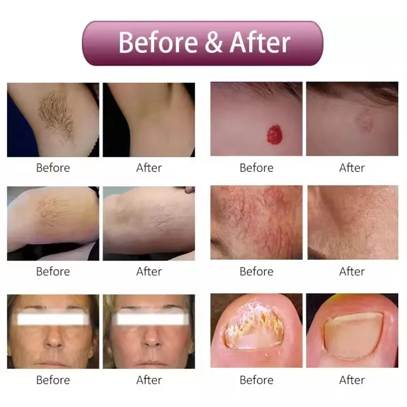 2025 ce profissional tela grande alex 755nm máquina venda quente rejuvenescimento da pele remoção do cabelo cabeça braço pés-fresco características it