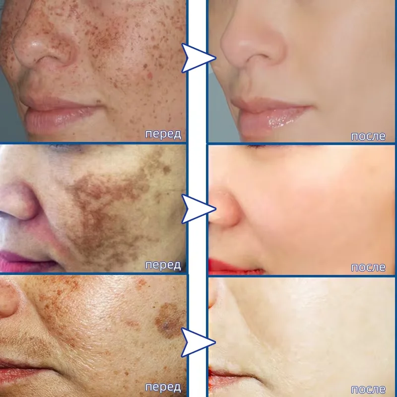 Potente crema blanqueadora eliminadora de manchas, ilumina la piel, elimina rápidamente la pigmentación de melanina, melasma, manchas oscuras, cuidado coreano de la piel