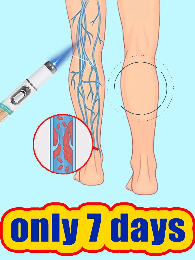 Gorąca wyprzedaż narzędzi do pielęgnacji nóg LEG: Pożegnaj się z dyskomfortem w nogach, łagodź uciski na nogi dzięki piórkowi z niebieskim światłem, rozwiąż problem z żylakami.