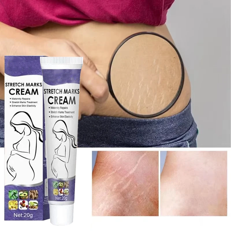 21Stretch Mark Removal Cream Postpartum Repair Cream For Pregnant Women Obesity Mark Growth Marks Thigh Firming Skin