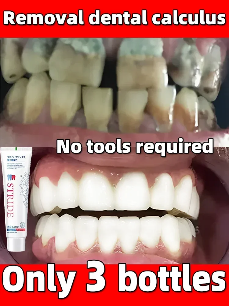 Dentífrico removedor de cálculo dental, Clareamento dos dentes, Boca remoção do odor, mau hálito, prevenção da periodontite, cavidade oral limpa