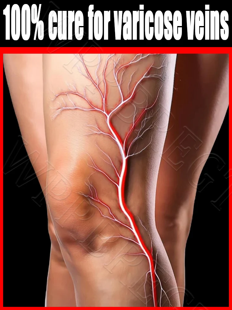 

Ннормально расширенные вены, инструмент для ухода за ногами с лазерной коррекцией вен