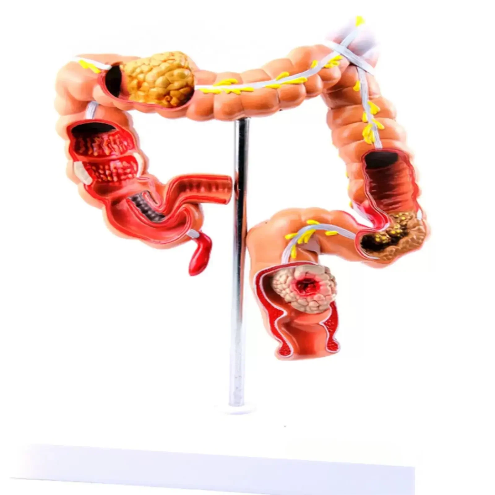 Human Colon Pathology Colonological Rectal Cancer Model Medical School