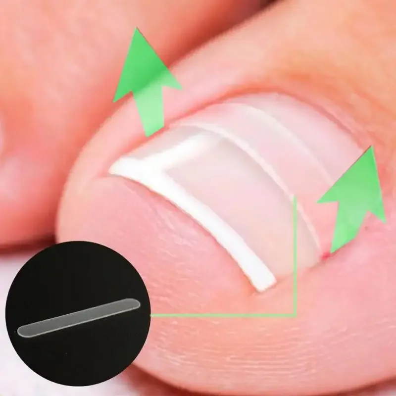 Ingrown Toenail Straightening Clip Transparent Elastic Patch Sticker Toe Nails Care Corrector Patch Brace Pedicure Tools