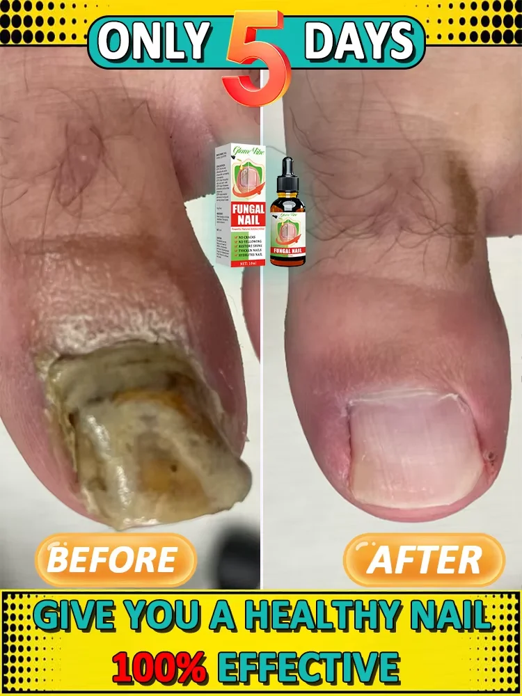 

Onychomycosis Terminator: Multi-effect essence to eradicate onychomycosis