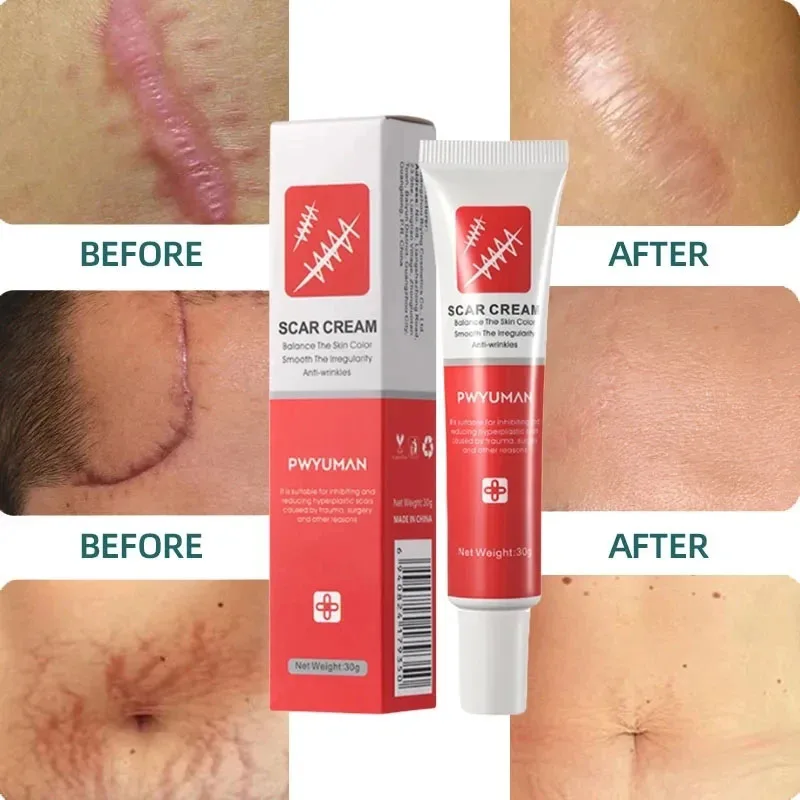 Herbal Scar Removal Cream Stretch Marks Burn Surgical Scars Treatment Gel Acne Spot Moisturizing Repair Facial Body Skin Care