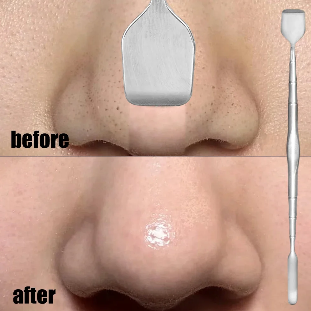 Extractor de espinillas de acero inoxidable, herramienta de eliminación de espinillas, aguja de acné de codo largo, limpiador de poros, raspado Facial de doble cabeza, 1-5 piezas