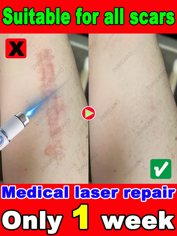 Ripara efficacemente vari tipi di cicatrici, è il assassino delle cicatrici
