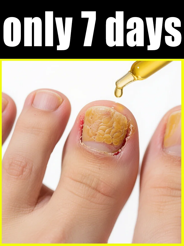 

Quickly eliminate fungus and restore healthy nails