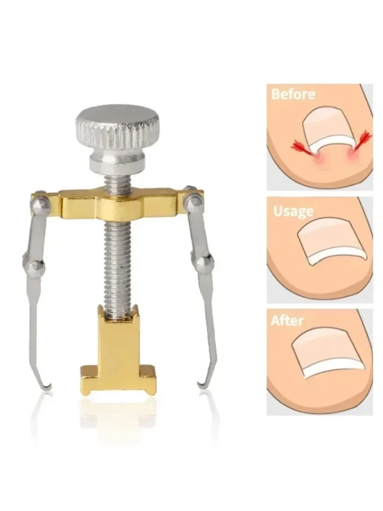 Correcteur d'ongles incarnés, Clip de redressage, pédicure, outils de soins des ongles, traitement de pédicure en acier inoxydable, Correction d'onyxis