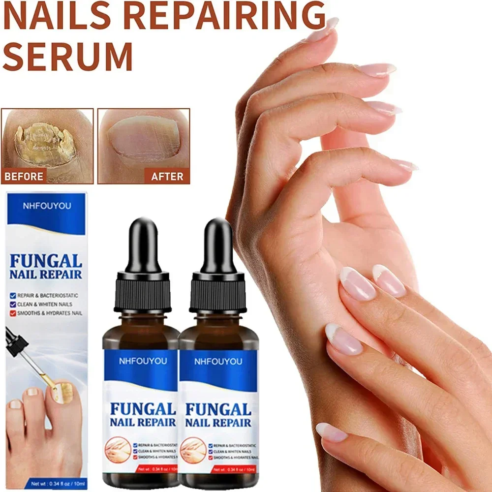 Nail Repair Líquido para Unhas descoloridas engrossadas amassadas, Fungals Renovação, Quebrado Rachado, S5F6