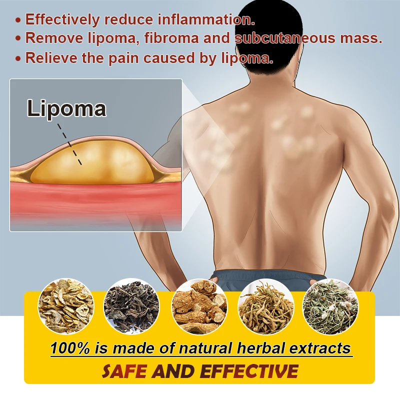 2Pcs Lipoma Removal Cream Antitumor Remove Fat Lump Ointment Nodular Skin Cyst Swelling Pain Relieve Herbal Plaster Care A1735