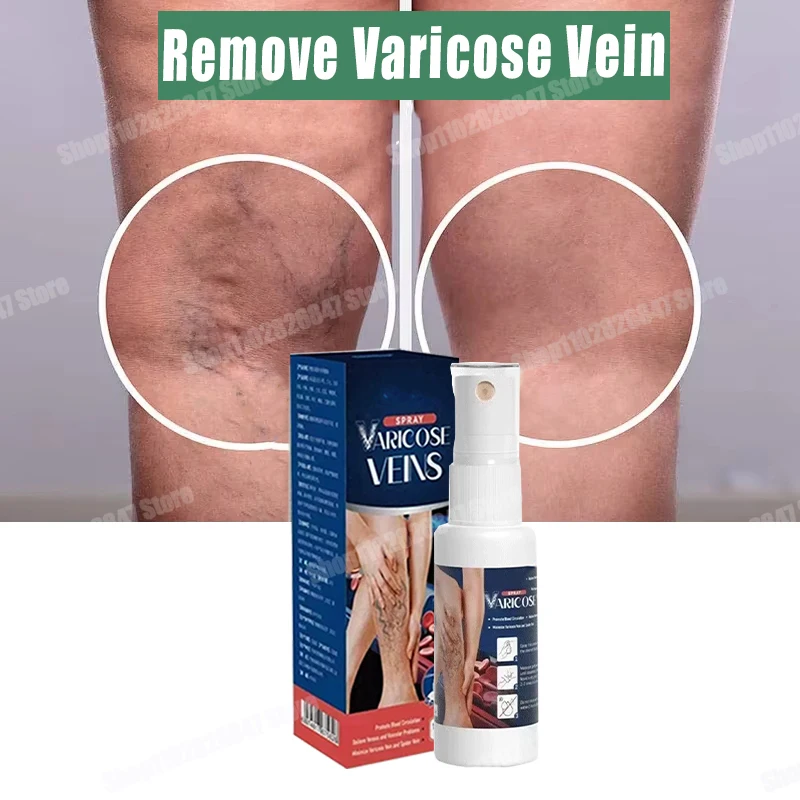 

Reliable Varicose Vein Spray Natural Herb Veins Soothing Essential Oil Spray Vasculitis Phlebitis Spider Vein Earthworm Leg Cure