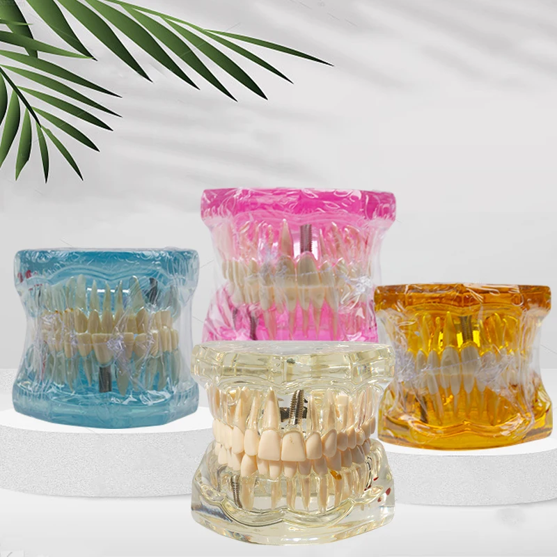 Removable multi pathology model transparent resin jawbone model, displaying the root canal condition of dental caries in implant