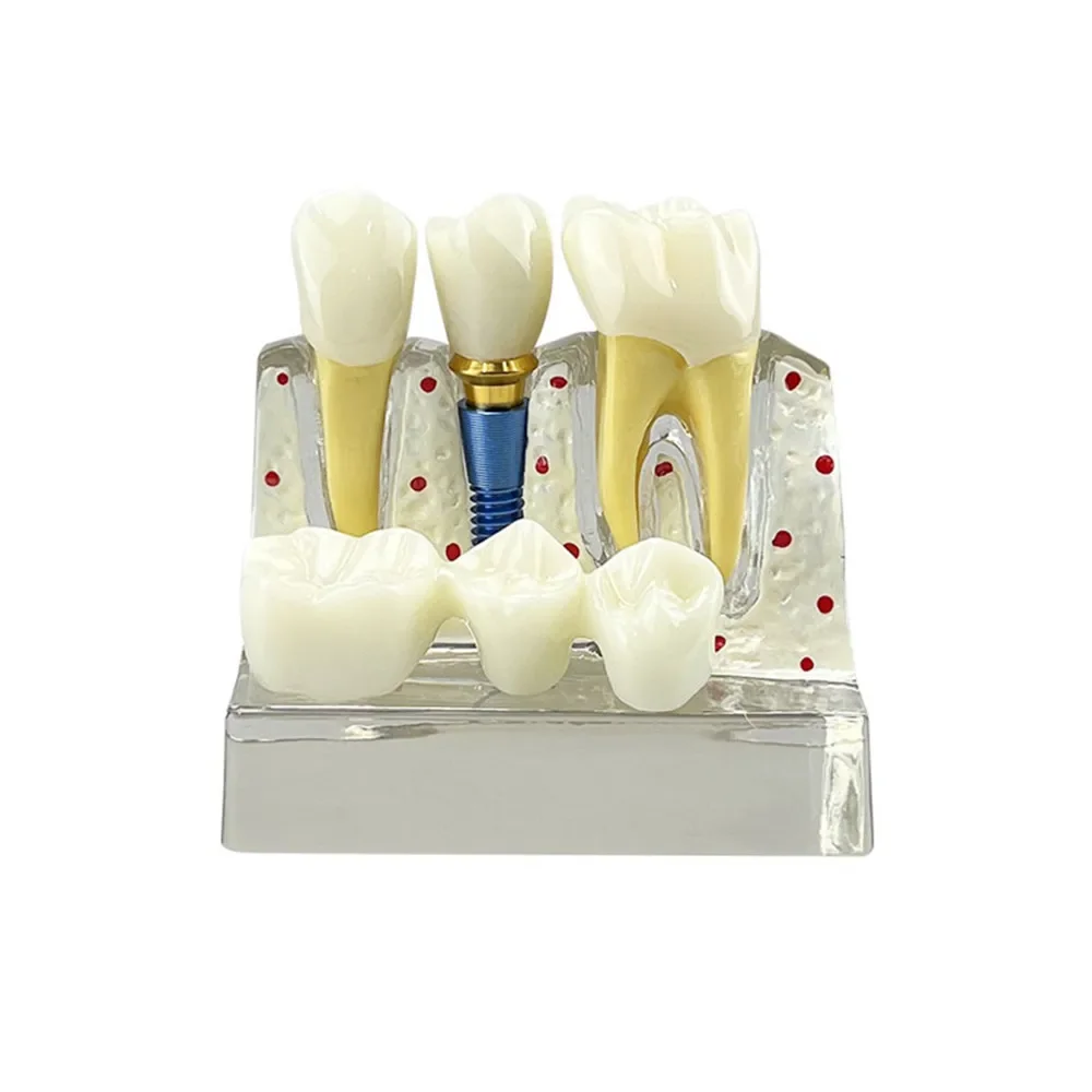 Dental Implant Training Model 4 Times Implant Analysis Crown Bridge Teeth Model Dentist Demonstration Model For Teaching Study