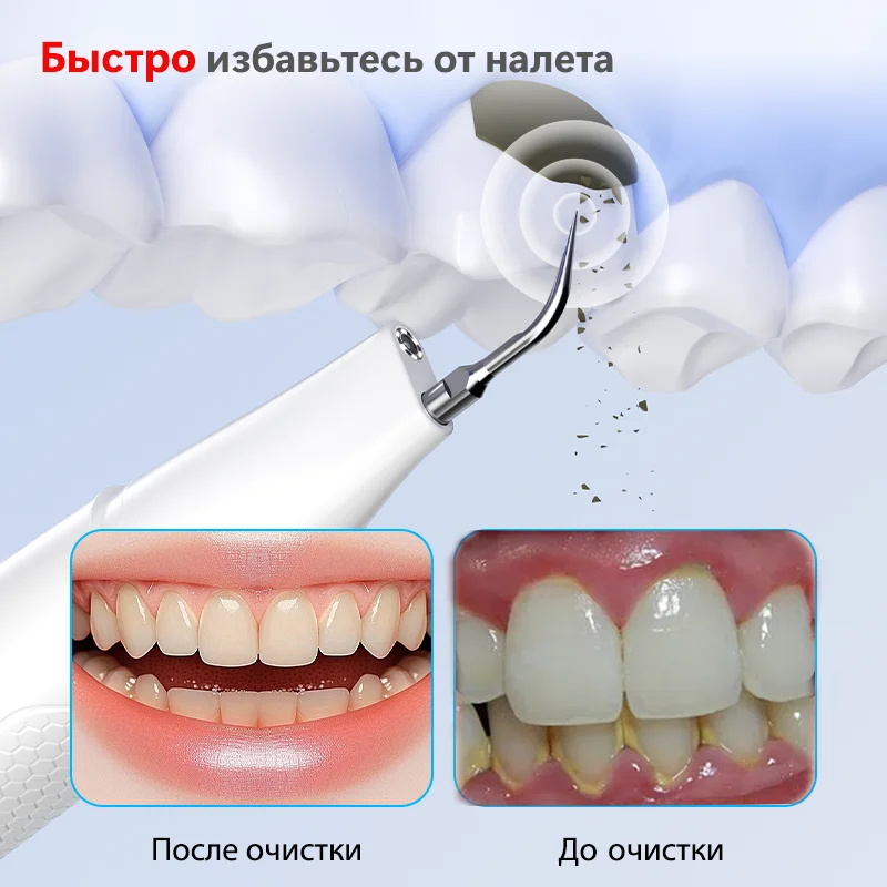 Ultrasonic Tooth Cleaner Kit Ultrasonic Electric Plaque & Tartar Remover Dental Mirror For Dental & Oral Checkup image 3