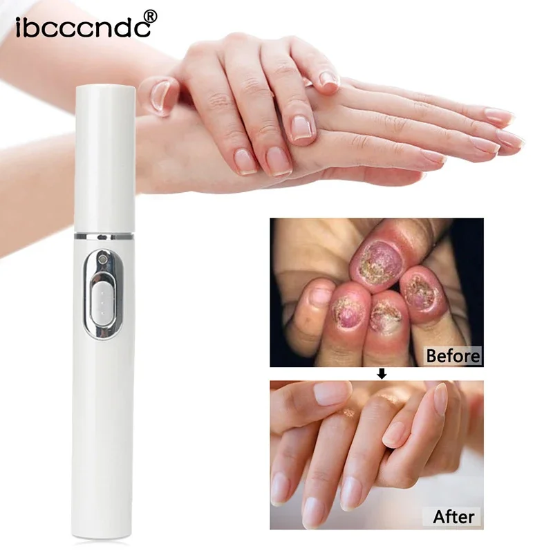 Hot Nail Fungal Pen Anti Fungus Blue Light Laser Pen Onychomycosis Painless Nail Repair Pen Nail Care Repair Serum Free Shipping