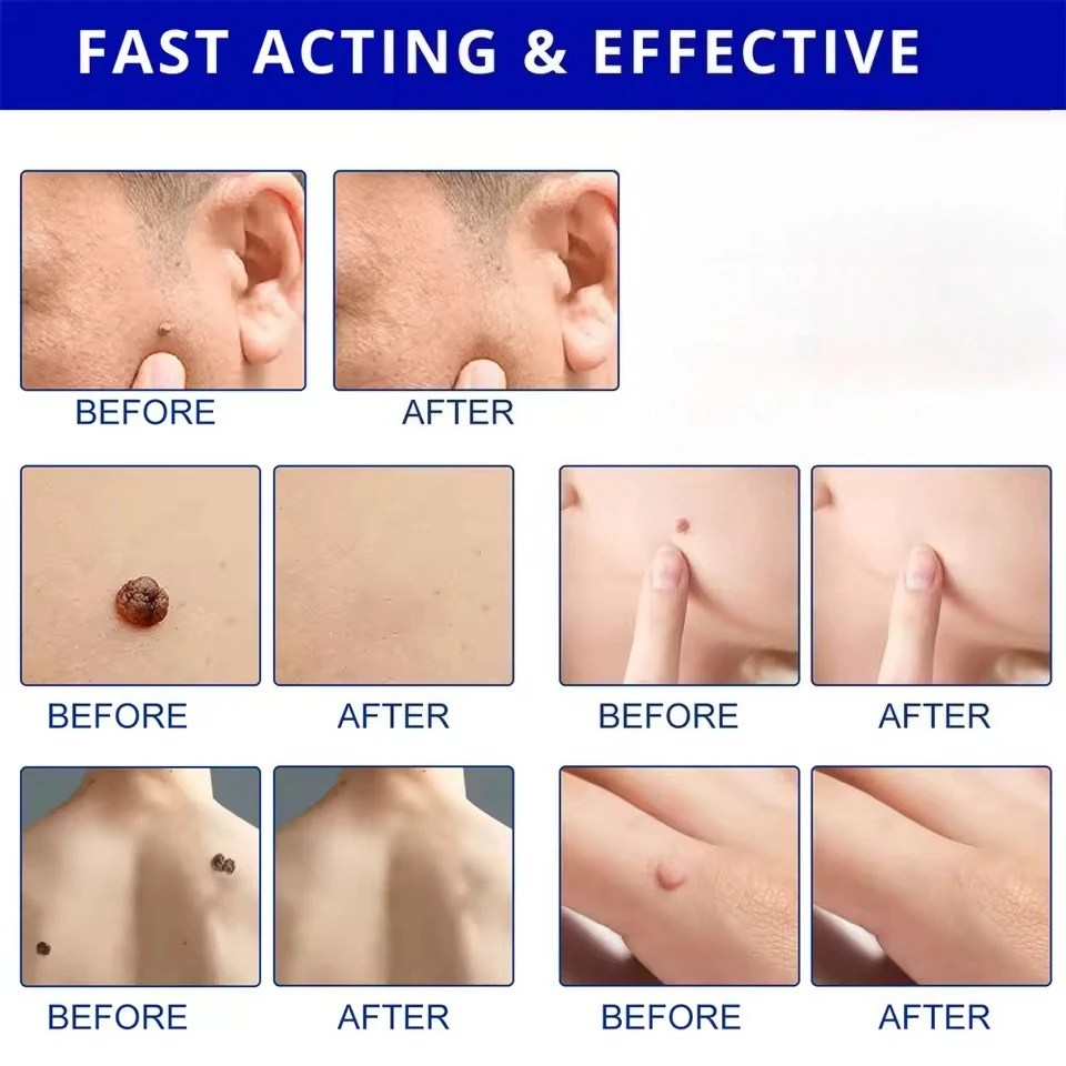 사마귀 제거 도구 레이저 펜 스킨 케어 펜, 바디, 얼굴, 피부, 현장 청소, 특히 가볍고 휴대용 홈 디자인