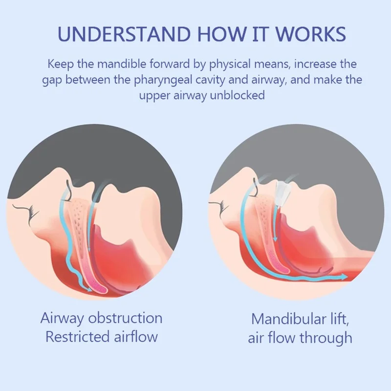 Anti Snurken Mond Guard Bretels Anti-Snurken Apparaat Man Stopper Anti Snurken Snurken Voor Slaap Beter Adem Aid apneu