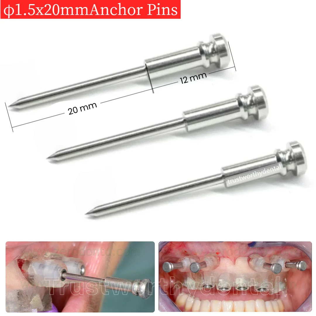 

Φ1.5 Dental Guided Anchor Pin Long Shaft Guided Implant Fixation Pin Template Fixation Pins Kit Fits NobelGuide
