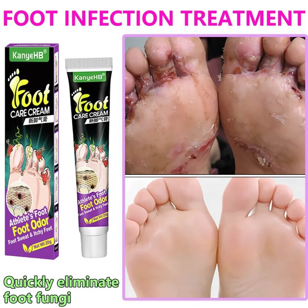 Anti-Foot Fungus Ointment Deodorant Care Products Foot Deodorant Creams Antiseptic and Antiperspirant Foot Skin Topical Cream