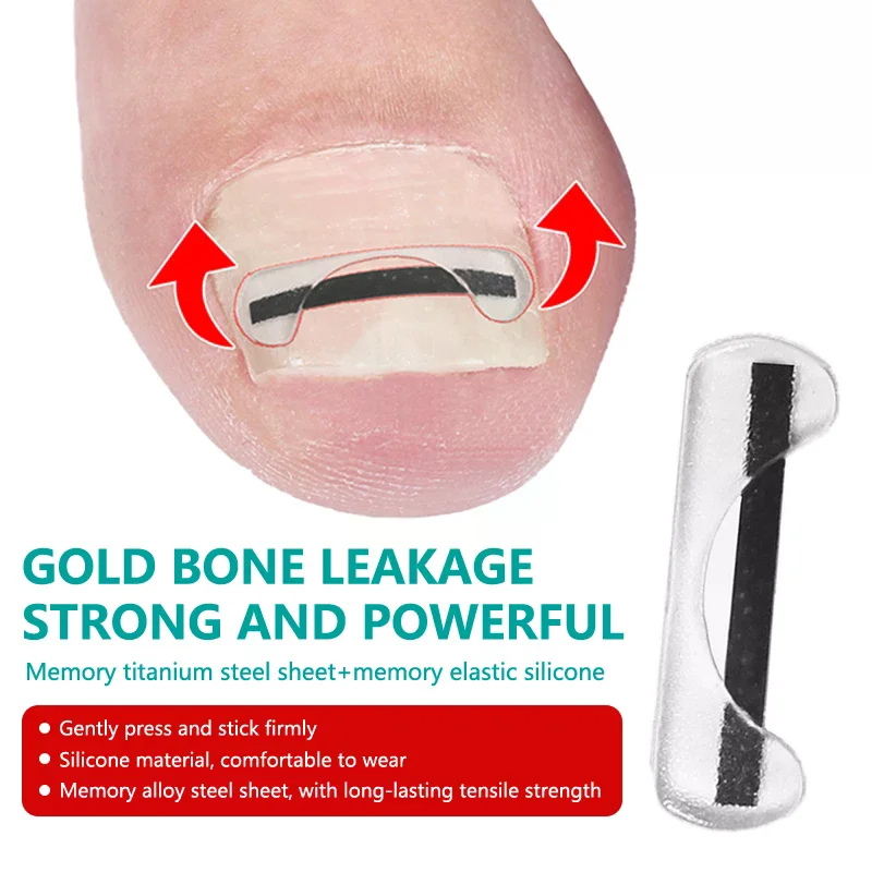 Ingrown Toenail Cor…