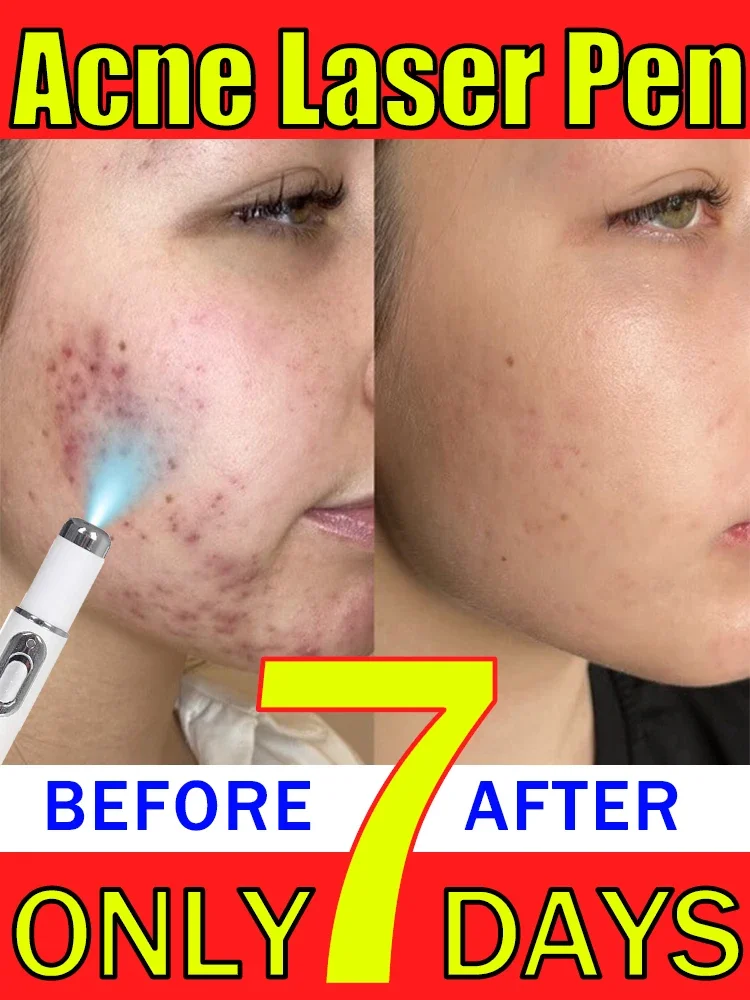 Acne laser pointer Acne serum Acne creams for the face