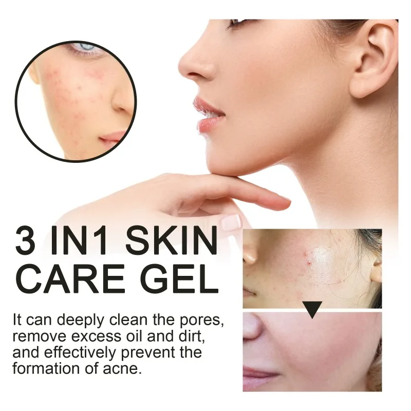 3 em 1 acne cuidados com a pele gel controle de óleo limpeza profunda clareamento acne cravos marcas hidratante suavização gel de reparação da pele