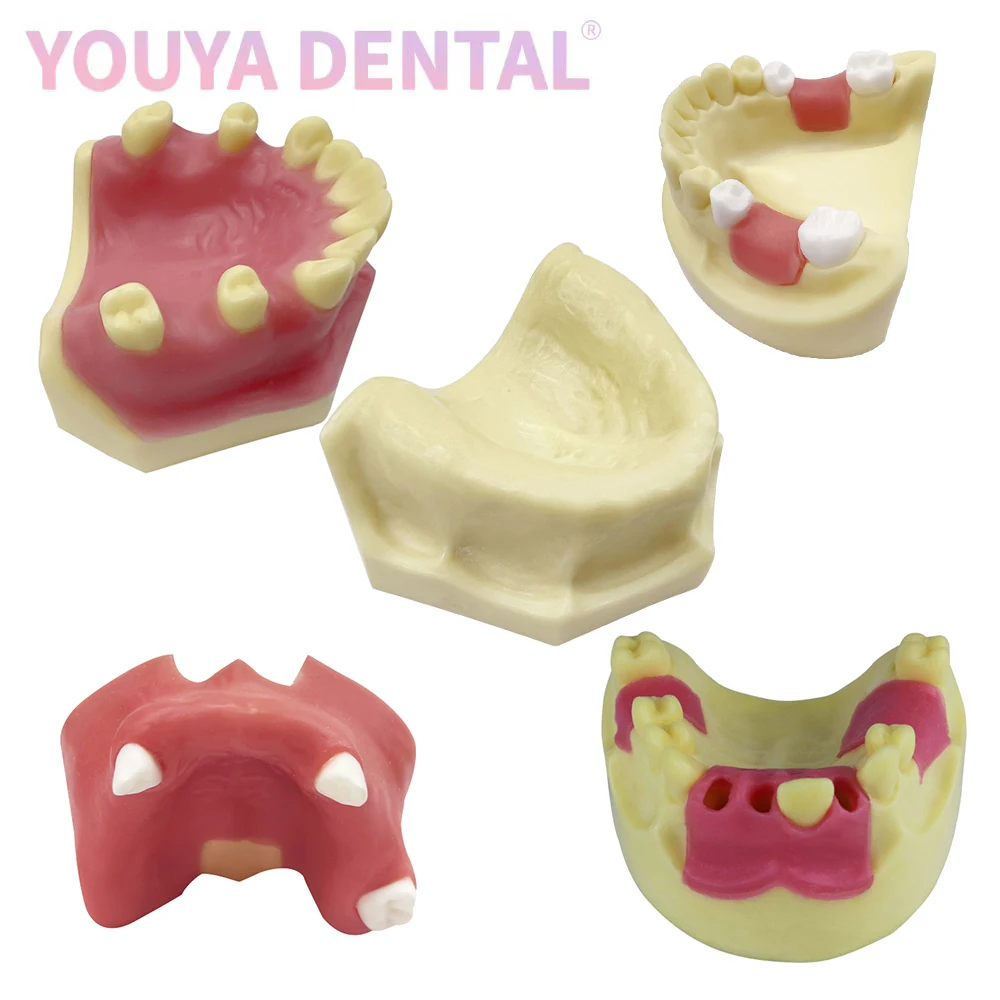 Dental Implant Practice Model Maxillary Mandibular Basic Implant Training Model With Soft Gums Suitable For Students To Practice