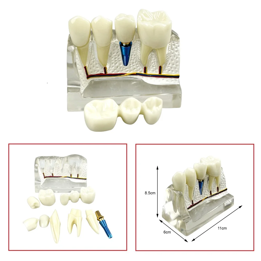 

Dental Demonstration Model Teach Implant Analysis Crown Bridge Detachable Model Caries Comparsion Study Models Tooth Decay Model