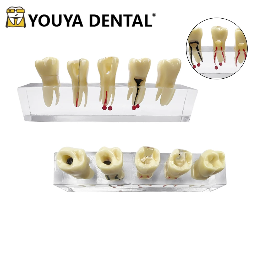 Transparent Root Canal Practice Model Disease Teeth Model for Dental Technician Endodontic Treatment Studying Teaching Models