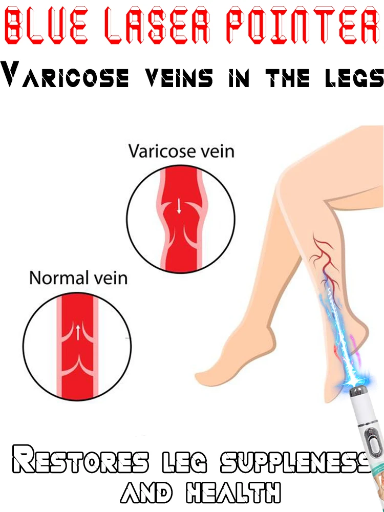 2e mini blauwlichtlaserpen, spataderenbehandeling, bescherming van uw benen.
