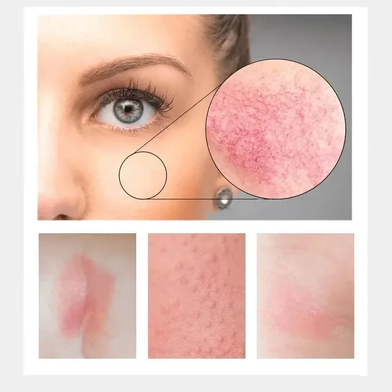Repair Facial Redness Cream Instant Spider Vein Remove Sensitive Skin Sooth Anti Redness Rosacea Treat Lotion Korean Cosmetics