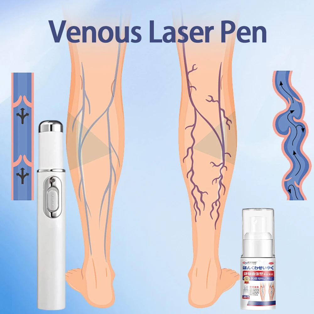 静脈瘤、クモ状血管、下肢の重みを軽減-脚の静脈レーザー治療ペン、血行改善ツール