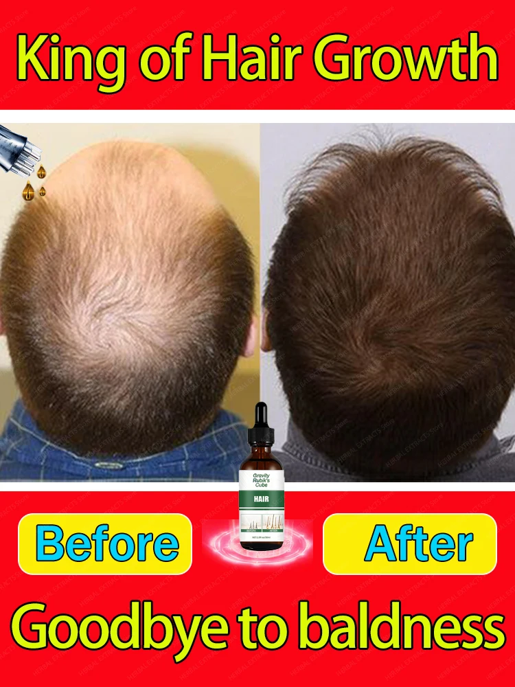 The most effective hair growth essential oil in 2025. Experts authoritatively certified,effective in repairing baldness and hair