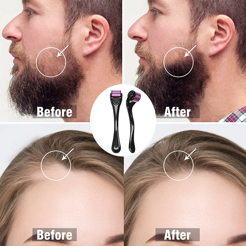 Derma Roller Micro Agulha, Crescimento De Barba Inoxidável, Tratamento Anti Hair Loss, Desbaste e Receding Cuidados Com A Pele, 540