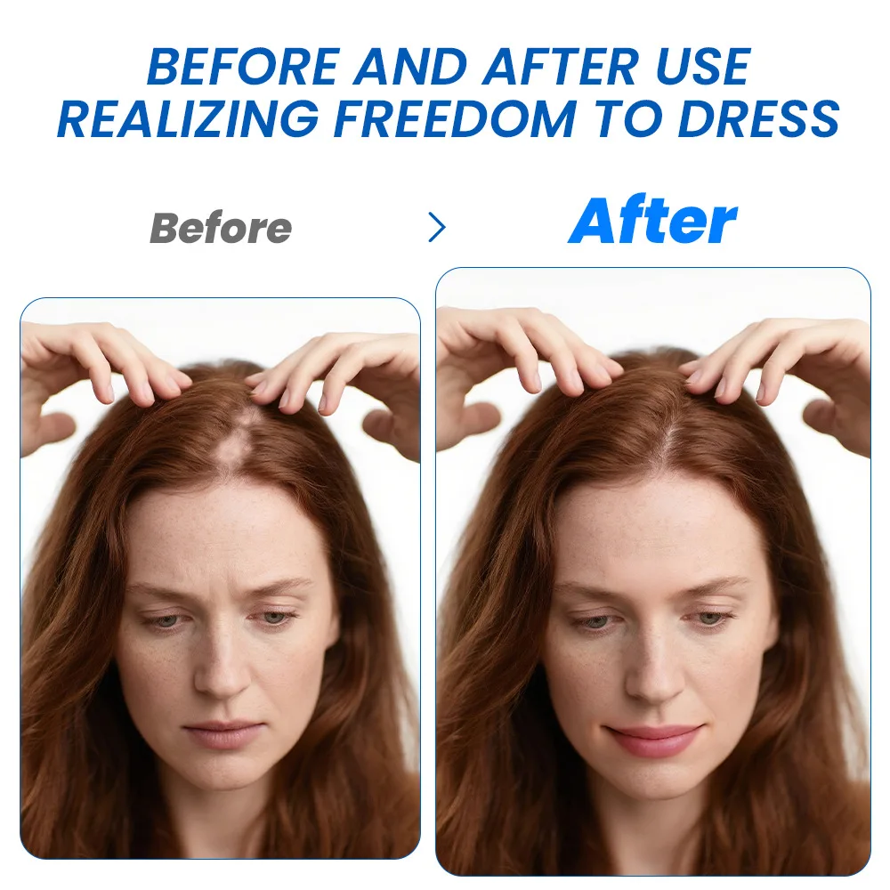 2025 Hot Selling Sumifan Bald Spot Cream Head Skin Care Cream Hair Care