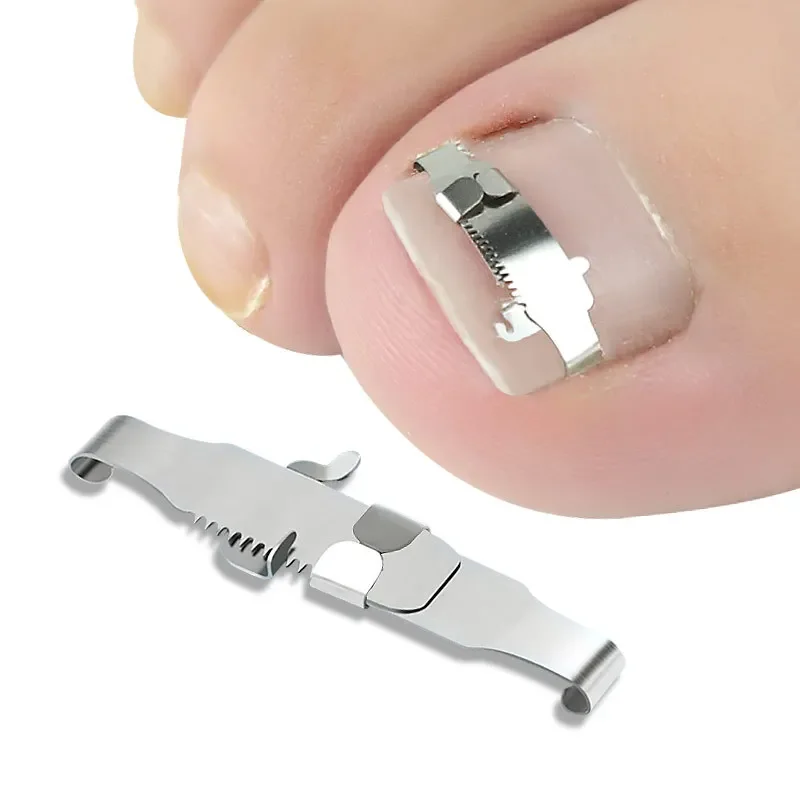 1 ensemble correcteur d'ongle incarné fixateur d'ongle orthopédique traitement de Correction d'ongle outils de soins des pieds outil de récupération intégré