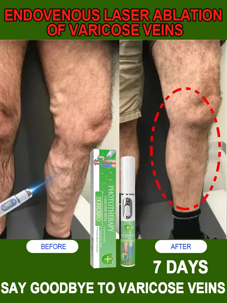 

Laser pen removes varicose veins